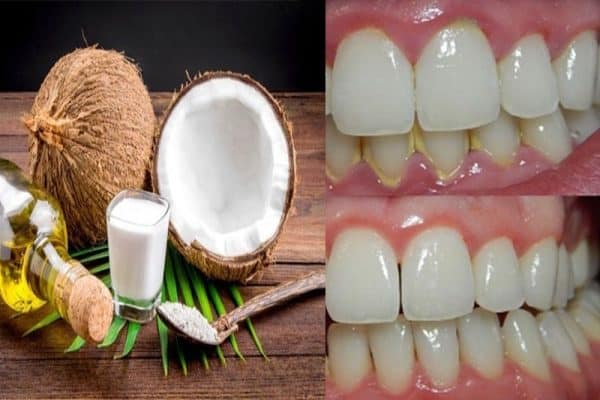 Sử dụng dầu dừa để lấy cao răng ngay tại nhà