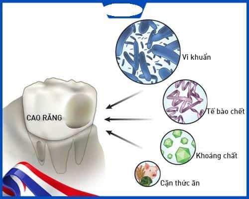 Những nguyên nhân tạo ra cao răng?