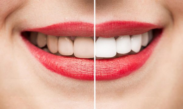 Tại sao cần chăm sóc răng sau khi tẩy trắng?